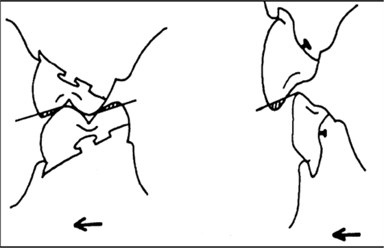 修復(fù)進(jìn)修醫(yī)生常見問題（全口義齒）-圖8-1.bmp