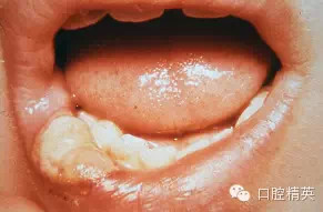 口腔局部麻醉并發(fā)癥及臨床處理 口腔局部麻醉并發(fā)癥及臨床處理