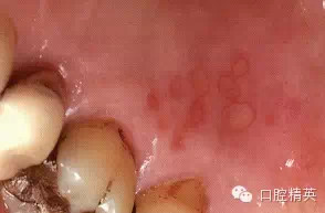 口腔局部麻醉并發(fā)癥及臨床處理 口腔局部麻醉并發(fā)癥及臨床處理