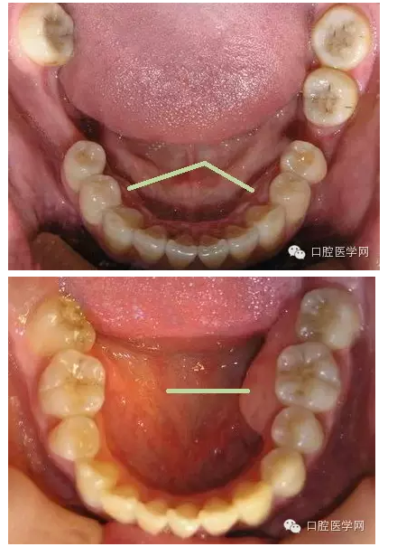 牙床骨質(zhì)突起的原因和處理措施