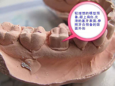 備牙應(yīng)注意的事項(xiàng)+備牙取摸損傷牙齦問題