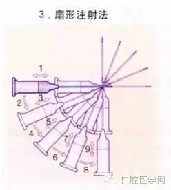 即使是老手也會失手的麻醉----下牙槽、舌、頰一次阻滯麻醉