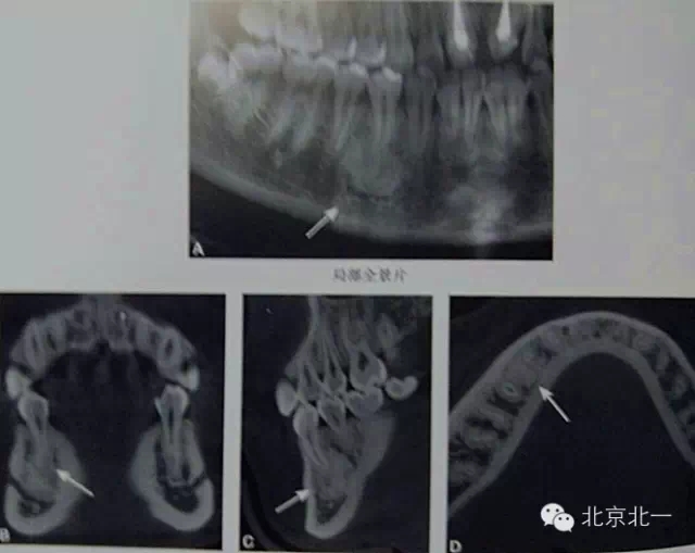 種植遇到骨島怎么辦