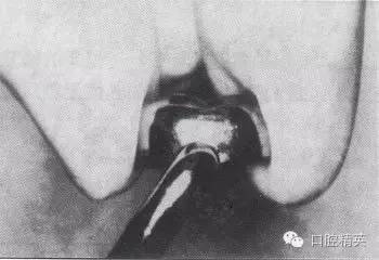 金屬預(yù)成冠修復(fù)-兒童乳牙