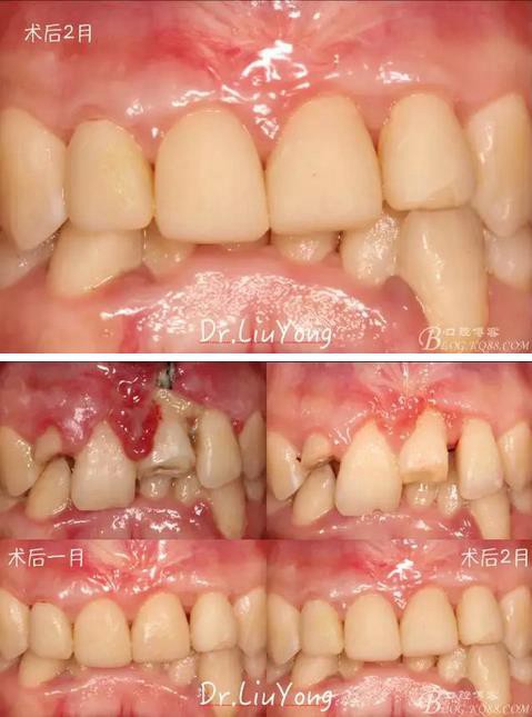 山西牙周劉勇：“前牙外傷患者的口腔多學科聯(lián)合治療”精彩案例分享