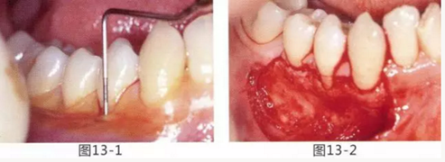 FGG法增大附著齦及根面覆蓋【牙齦－牙槽黏膜的問(wèn)題】.png