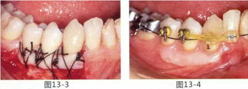 FGG法增大附著齦及根面覆蓋【牙齦－牙槽黏膜的問(wèn)題】.png