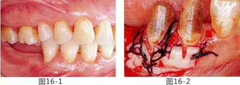 FGG法增大附著齦及根面覆蓋【牙齦－牙槽黏膜的問(wèn)題】.png