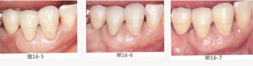 FGG法增大附著齦及根面覆蓋【牙齦－牙槽黏膜的問(wèn)題】.png