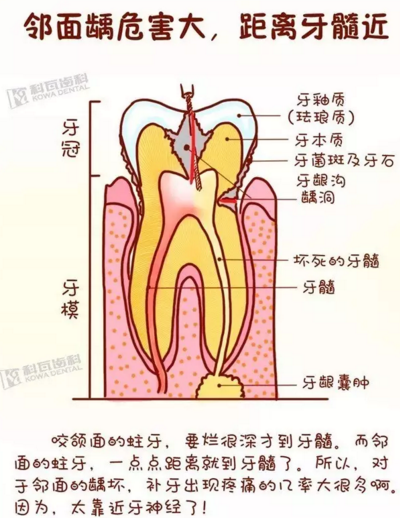 牙縫間的黑線(xiàn)是鄰面齲，還一壞壞倆，巧用它幫你渡過(guò)一“劫”