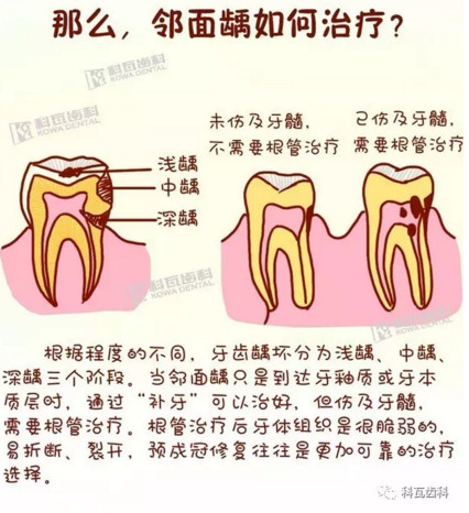 牙縫間的黑線(xiàn)是鄰面齲，還一壞壞倆，巧用它幫你渡過(guò)一“劫”