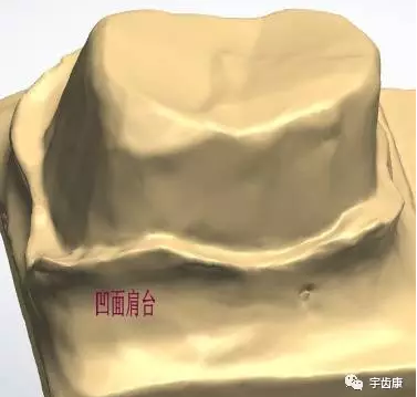 影響全瓷牙冠裂的因素有哪些？