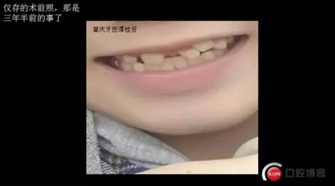 CBCT導(dǎo)航下多生牙拔除，混合牙列期矯正思考！