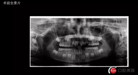 CBCT導(dǎo)航下多生牙拔除，混合牙列期矯正思考！