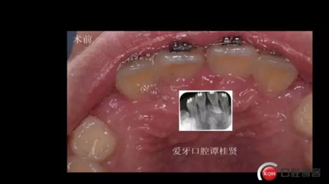 CBCT導(dǎo)航下多生牙拔除，混合牙列期矯正思考！