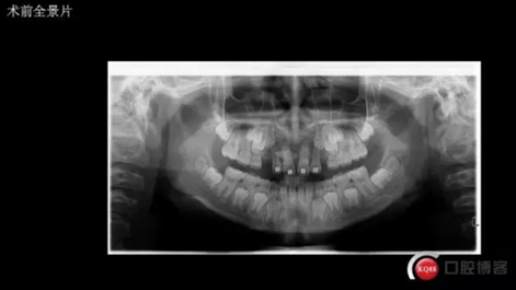 CBCT導(dǎo)航下多生牙拔除，混合牙列期矯正思考！