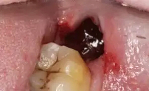 拔牙干槽癥可怕嗎？