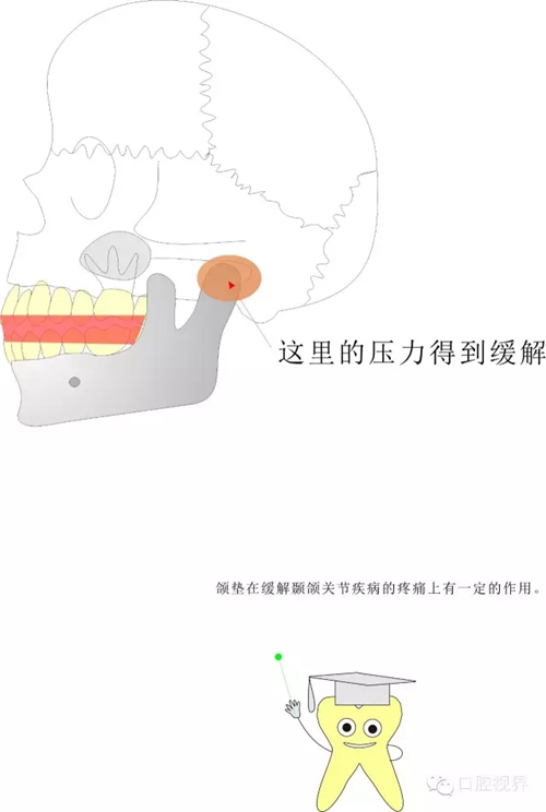 【愛牙科普知識300問】 “什么是頜（牙）墊？”