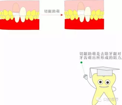  “什么是牙周袋沖洗？”