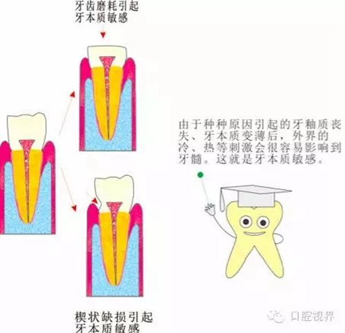 【愛牙科普知識300問】 “什么是牙本質(zhì)敏感？”