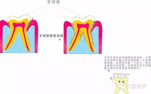 【愛牙科普知識300問】 “什么是牙本質(zhì)敏感？”