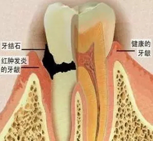 【愛牙科普】口腔謠言終結(jié)者——每天刷牙，洗牙該不該？！