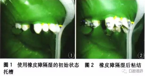 橡皮障，是用還是不用？