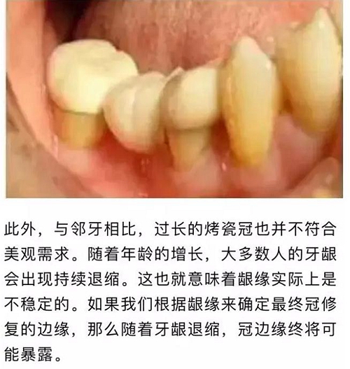 做全冠修復(fù)時基牙根面暴露，如何備牙？