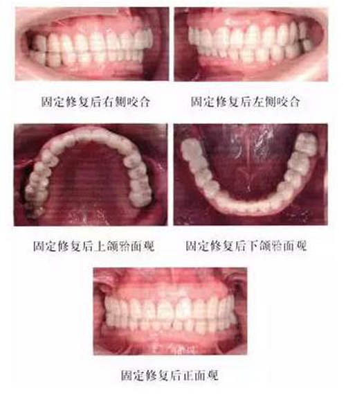 正畸修復聯(lián)合咬合重建1例 正畸修復聯(lián)合咬合重建1例