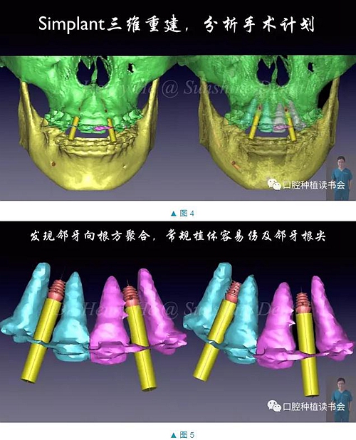 短種植體在前牙美學(xué)區(qū)應(yīng)用的臨床病例報道（上）