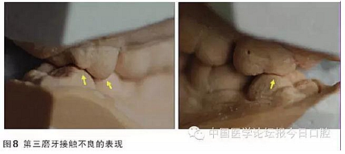 凸凹式后牙咬合接觸及其臨床意義——王美青教授