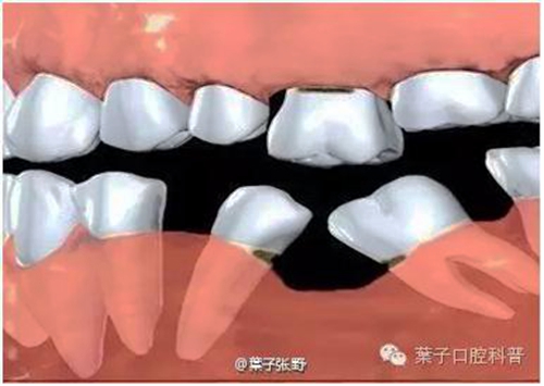 乳牙缺失致恒牙“亂長(zhǎng)”，這個(gè)“間隙保持器”可預(yù)防