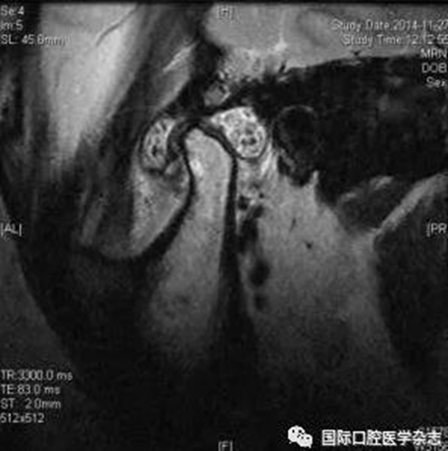 張清彬談張口受限 