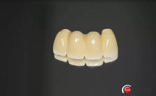 一例前牙重度牙周病8個(gè)月的種植漫長修復(fù)