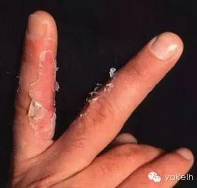 正畸中與材料相關(guān)的副作用---樹脂基材料的過敏反應(yīng) 正畸中與材料相關(guān)的副作用---樹脂基材料的過敏反應(yīng)