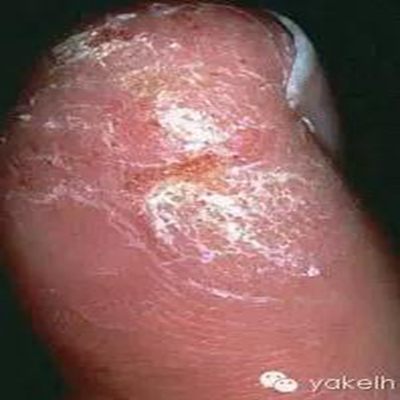 正畸中與材料相關(guān)的副作用---樹脂基材料的過敏反應(yīng) 正畸中與材料相關(guān)的副作用---樹脂基材料的過敏反應(yīng)