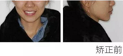 醫(yī)生方案里的鄰面去釉，究竟是什么？