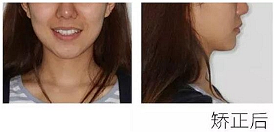 醫(yī)生方案里的鄰面去釉，究竟是什么？