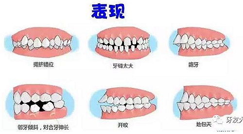 “發(fā)現(xiàn)即矯正”12歲前必須處理的20種兒童牙頜畸形 