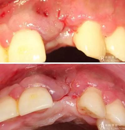 一例上前牙種植失敗病例的補(bǔ)救