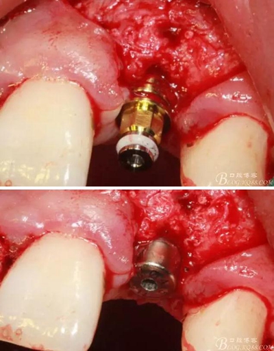 一例上前牙種植失敗病例的補(bǔ)救