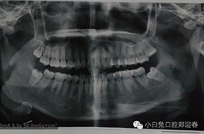 (原創(chuàng))//圖解微創(chuàng)舒適拔牙全過(guò)程 