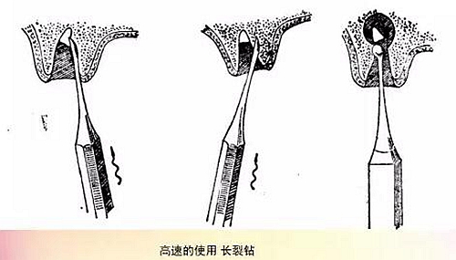 拔牙斷根的去與留？