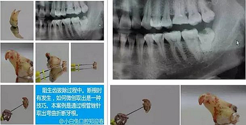 拔牙斷根的去與留？