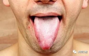 艾滋病早期重要癥狀:口腔的各種表現(xiàn) 艾滋病早期重要癥狀:口腔的各種表現(xiàn)