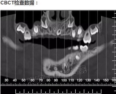 多生牙的拔除總原則：早發(fā)現(xiàn)，早處理！