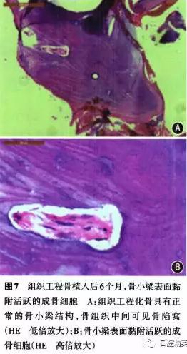 組織工程骨修復(fù)上頜骨缺損及牙種植一例 