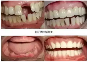 一位資深牙醫(yī)的總結(jié) | 如何減輕患者鑲牙后酸痛癥狀的措施！