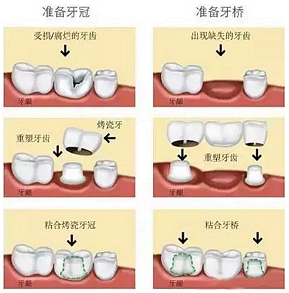 一位資深牙醫(yī)的總結(jié) | 如何減輕患者鑲牙后酸痛癥狀的措施！