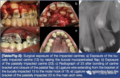文獻(xiàn)優(yōu)秀正畸病例賞析--牙周加速成骨正畸（PAOO）輔助的腭側(cè)埋伏尖牙牽引矯治及5年跟蹤隨訪